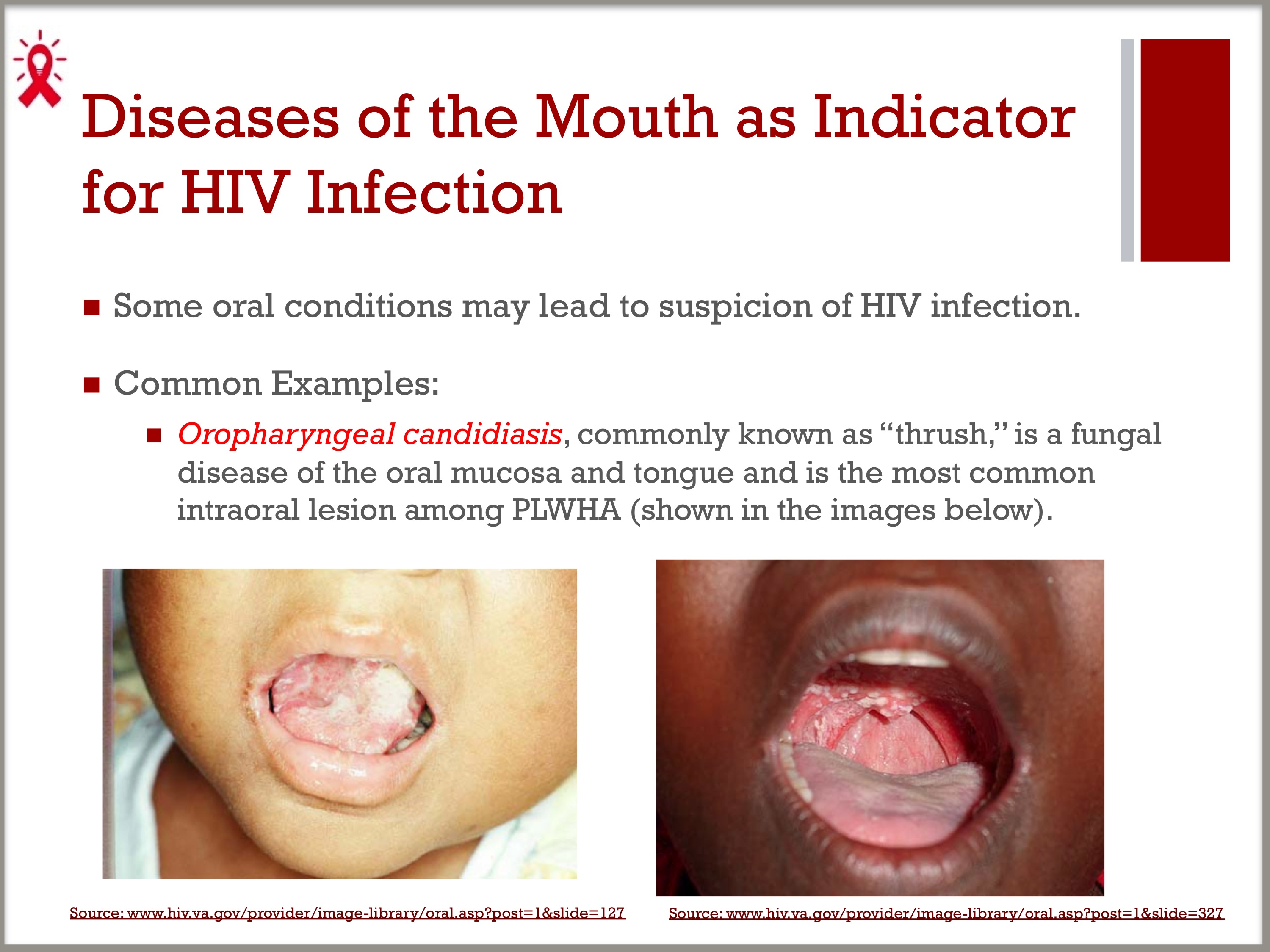 hiv tongue lesions