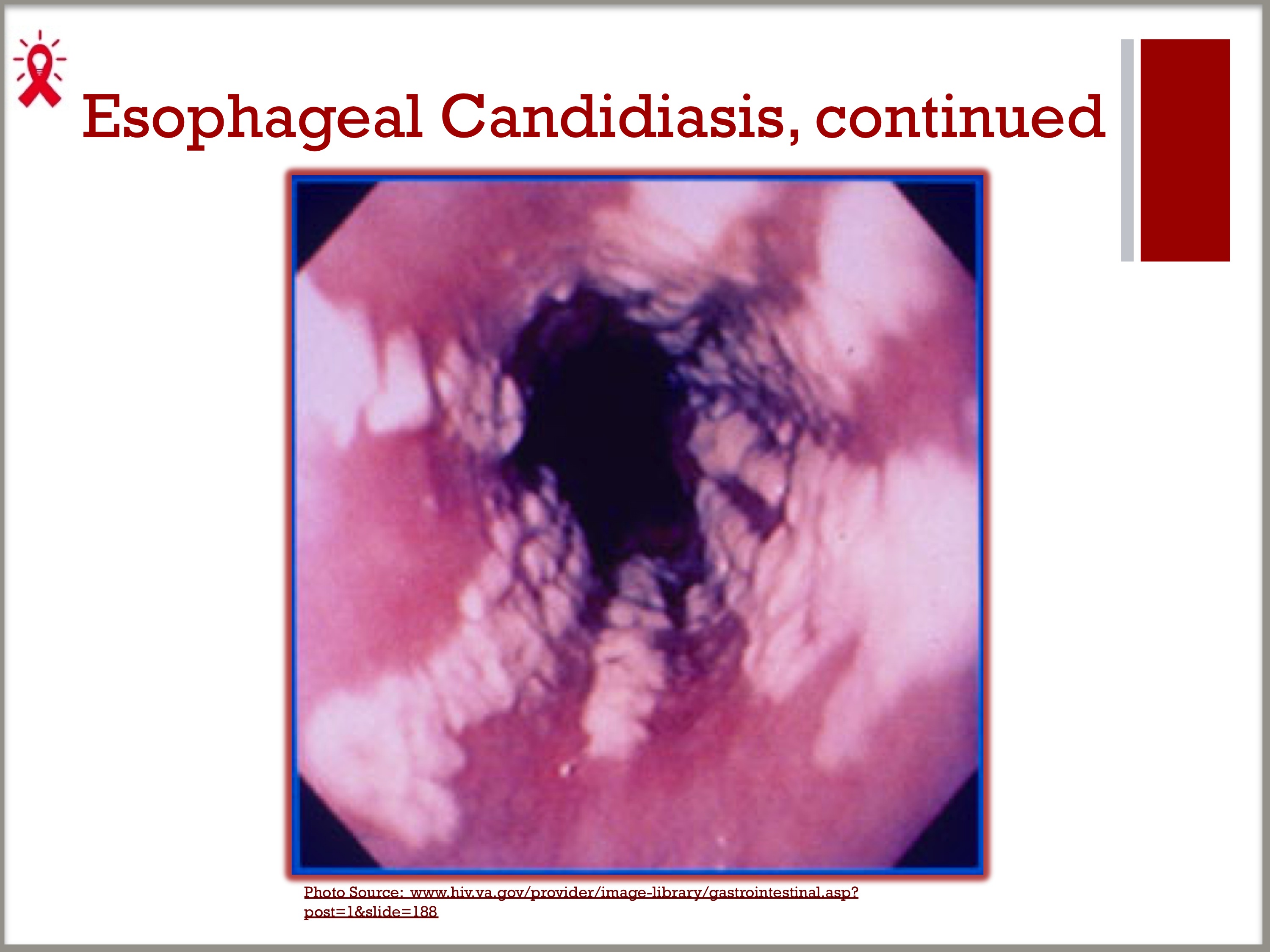 Esophageal Candidiasis