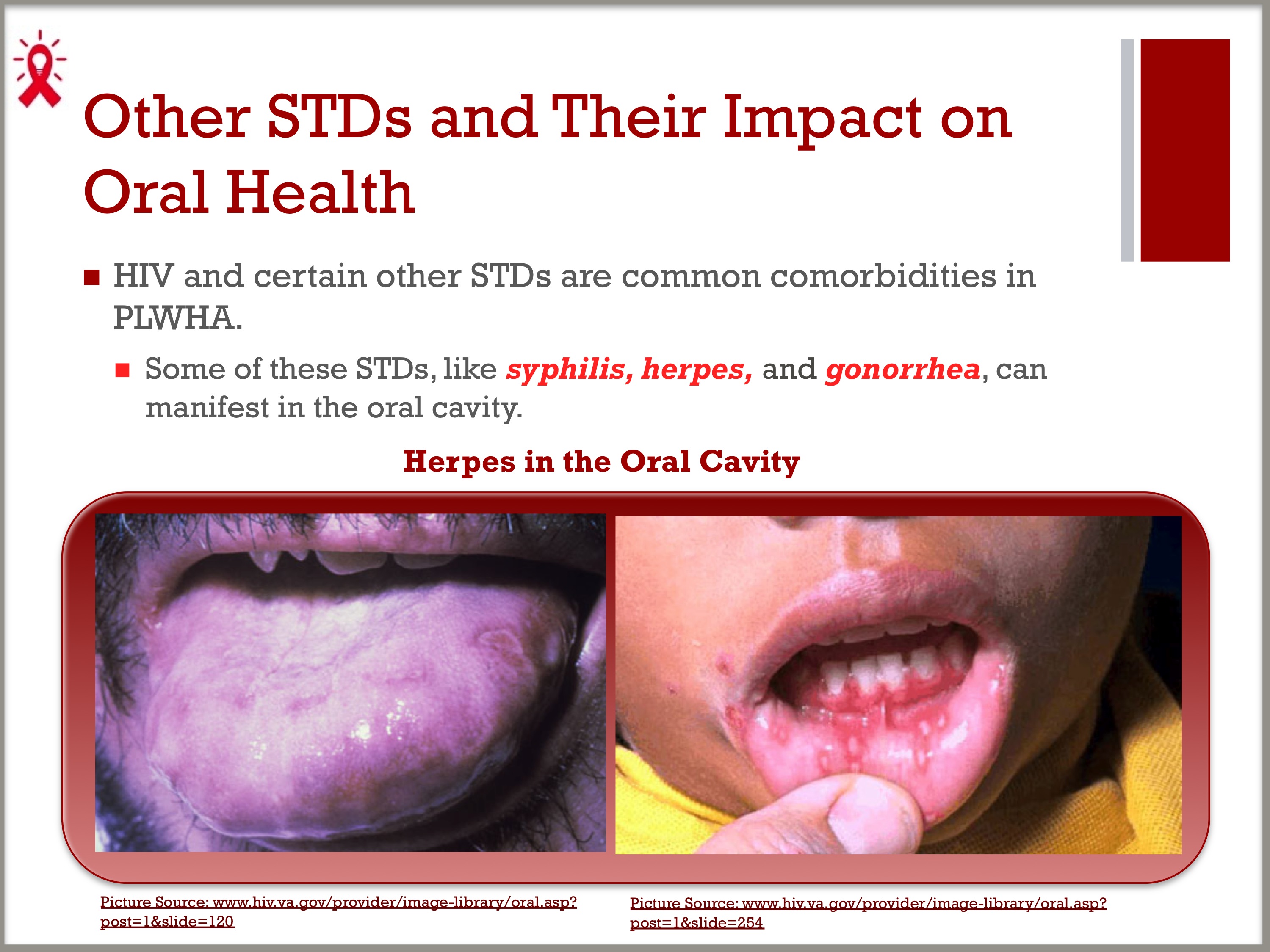 hiv tongue lesions