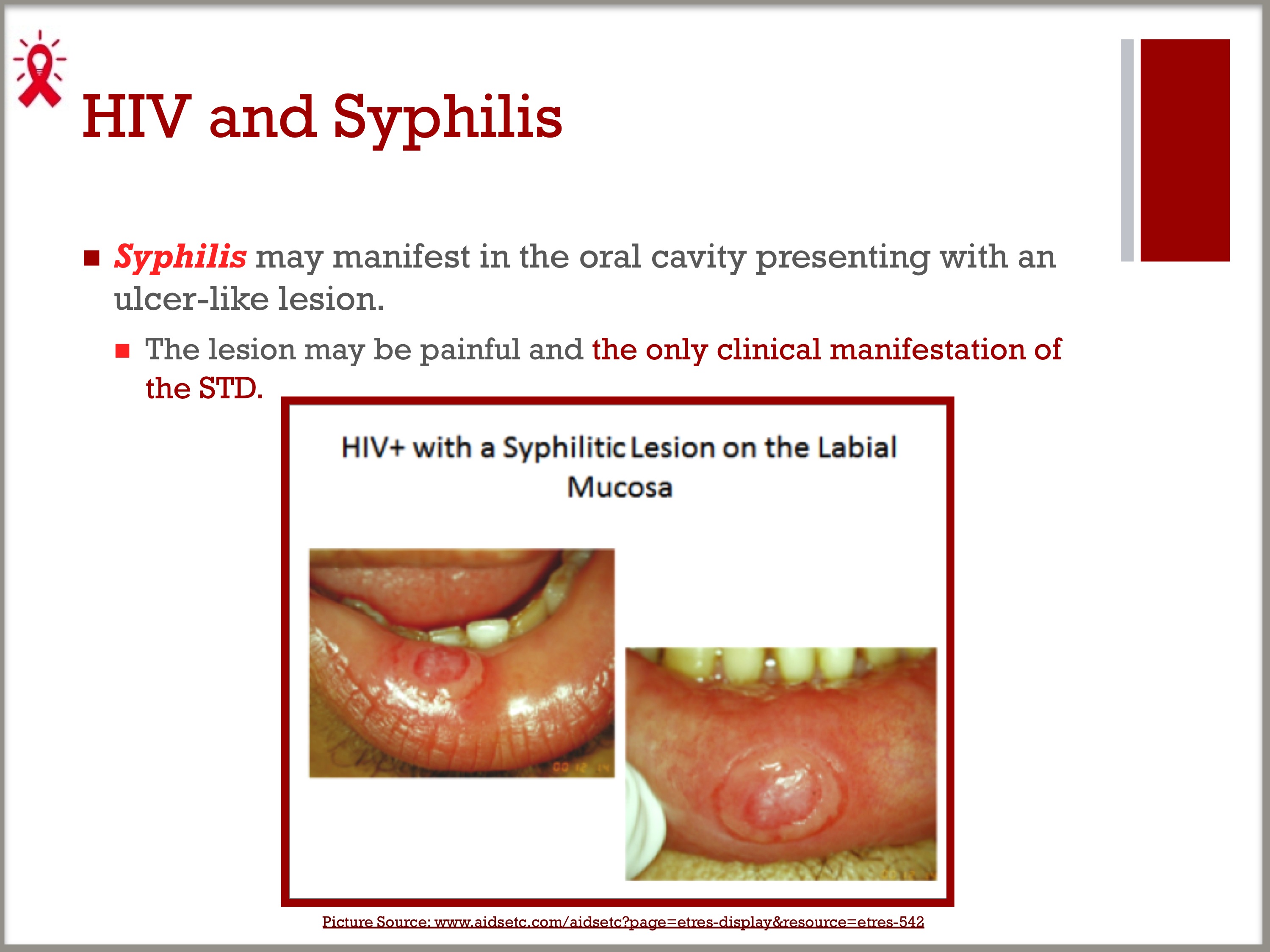 hiv tongue lesions