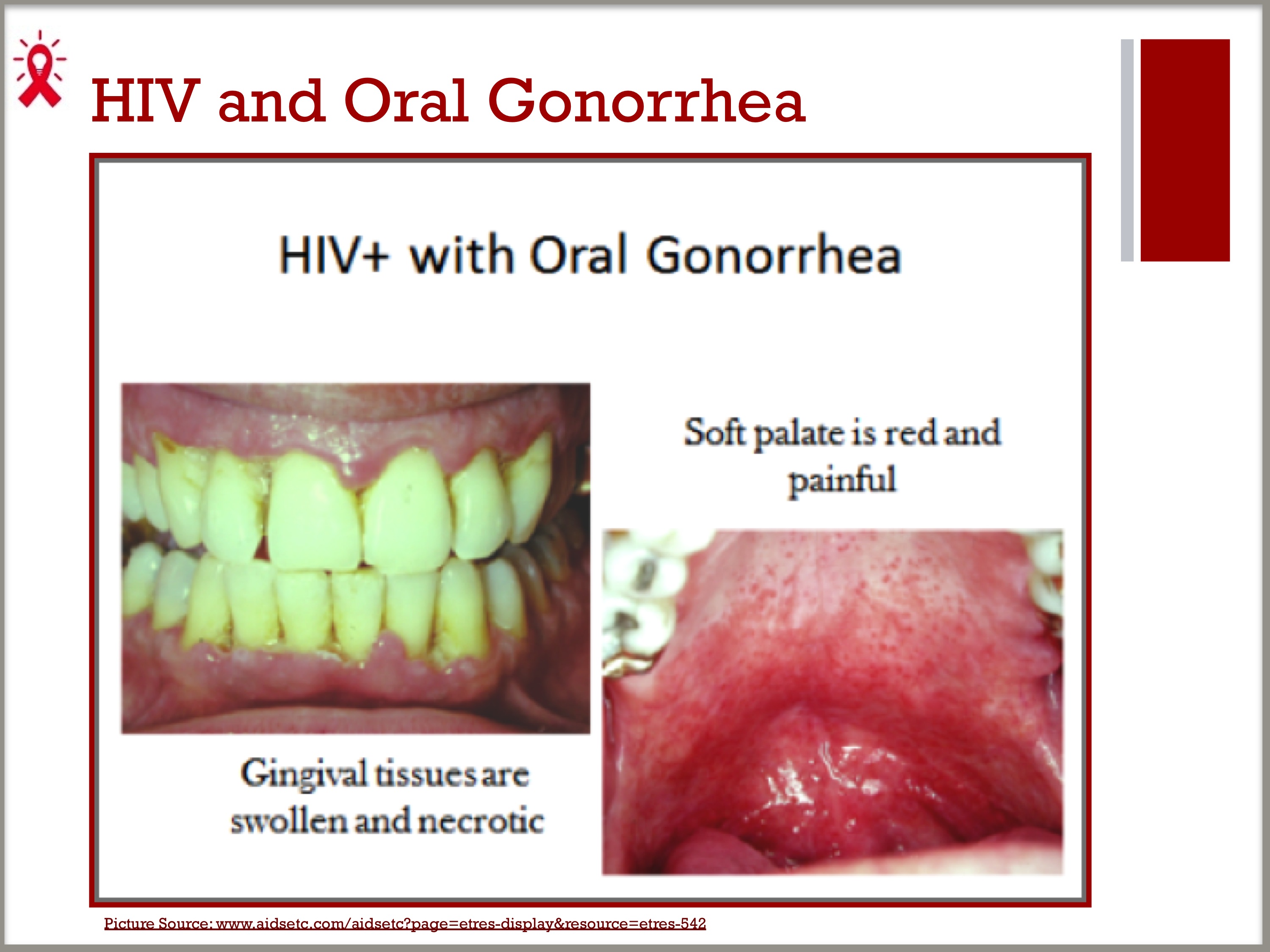 gonorrhea mouth sore